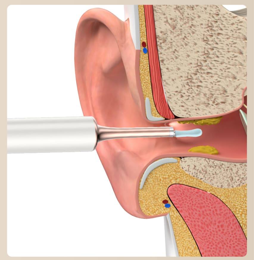 ørevoksfjerner, der renser øret